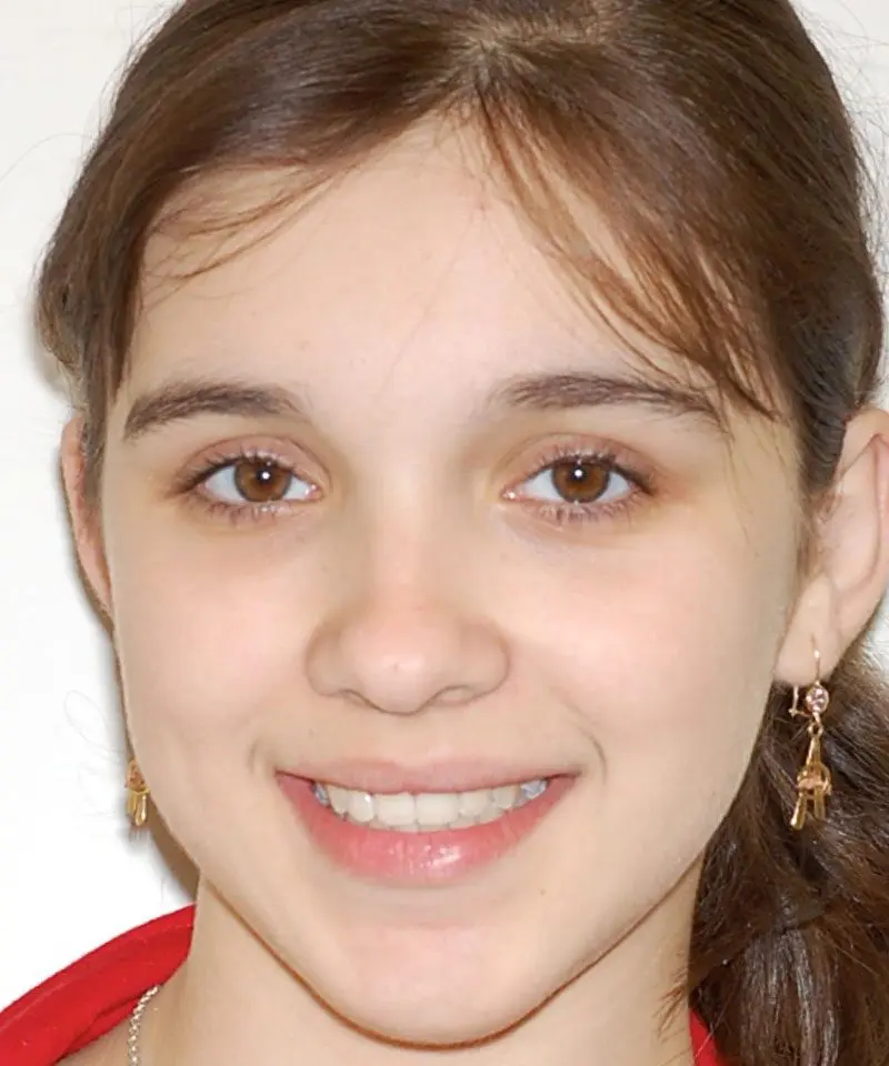 A girl smiling showing her teeth - Smilebliss