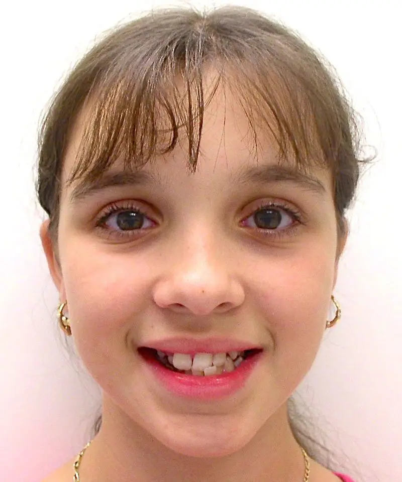 A girl smiling with misaligned teeth - Smilebliss