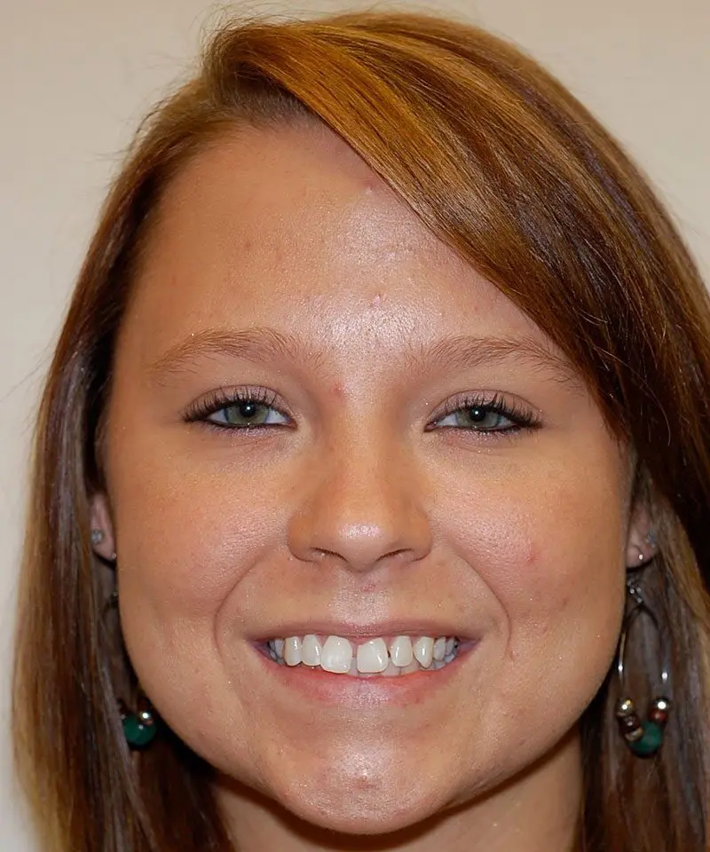 Woman Showing Her teeth with gap - Smilebliss