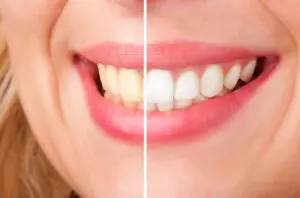 before and after teeth whitening