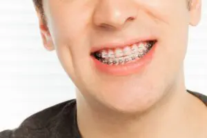 traditional braces