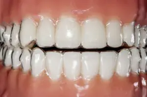 invisible braces orthodontic removable aligners for teeth treatm