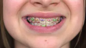 Teen girl with braces smiling close-up. Girl with colored braces on her teeth.
