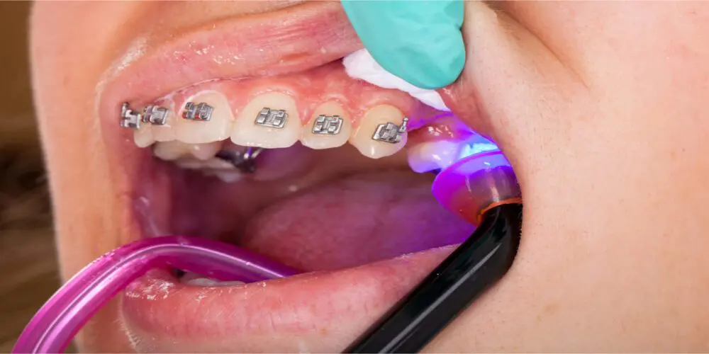 Denta Braces - Smilebliss