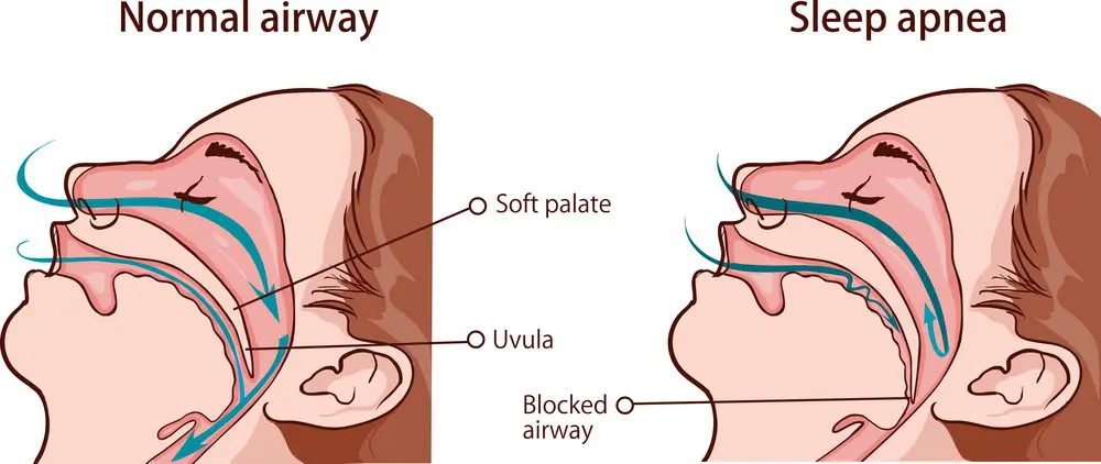 Sleep apnea syndrome ilustration - Smilebliss