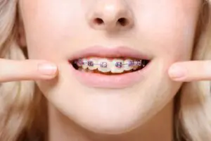 Braces
