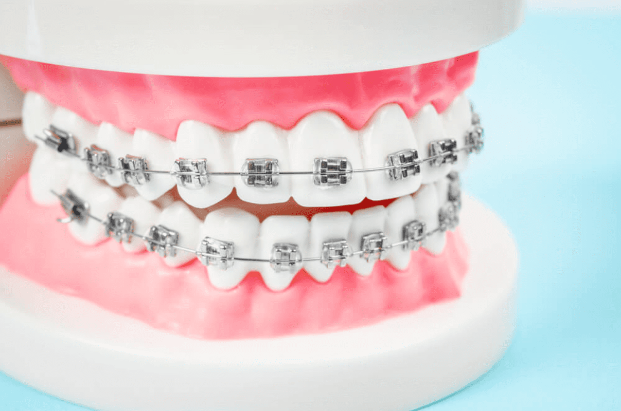 Cost of Braces-Smilebliss