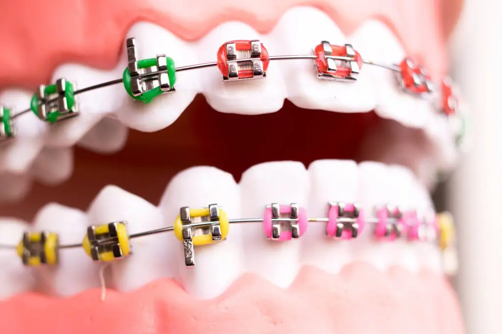 Dental Metal Braces with colored bands