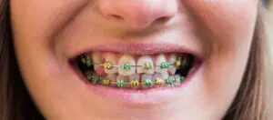Closeup of smiling woman with colored braces