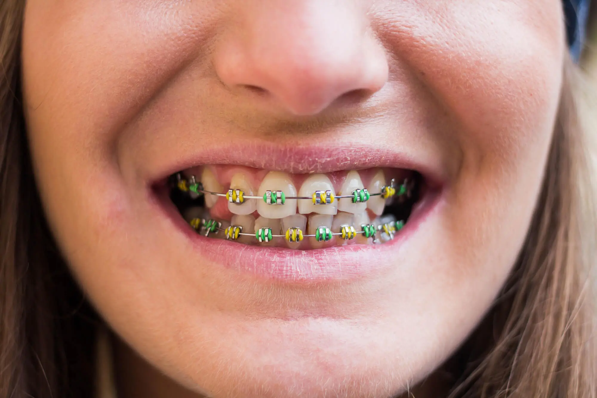 Closeup of smiling woman with colored braces