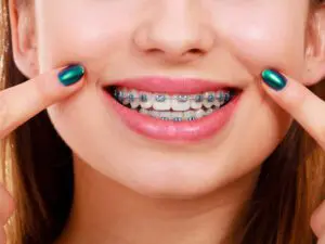 Smiling with braces-Smilebliss