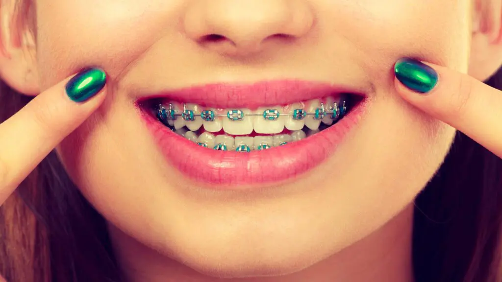 Woman showing her teeth with braces