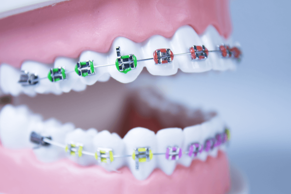 Colored Bands