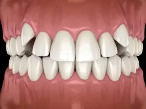 a photo of an overcrowded teeth