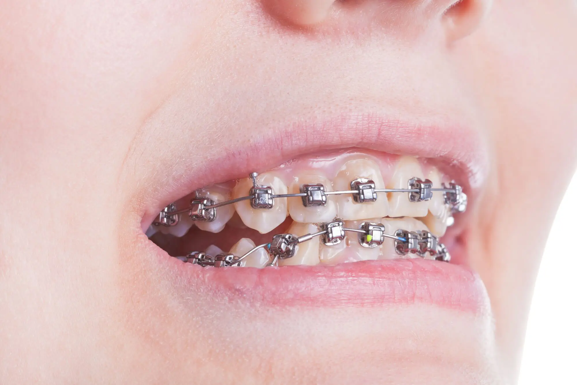Closeup Self Ligating Braces