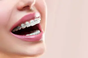 Close up the open mouth with self ligating braces