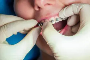 female dental open mouth with fixator gel braces at the reception