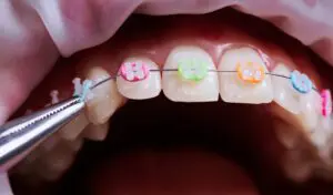 Dentist removing rubber bands from patient braces.