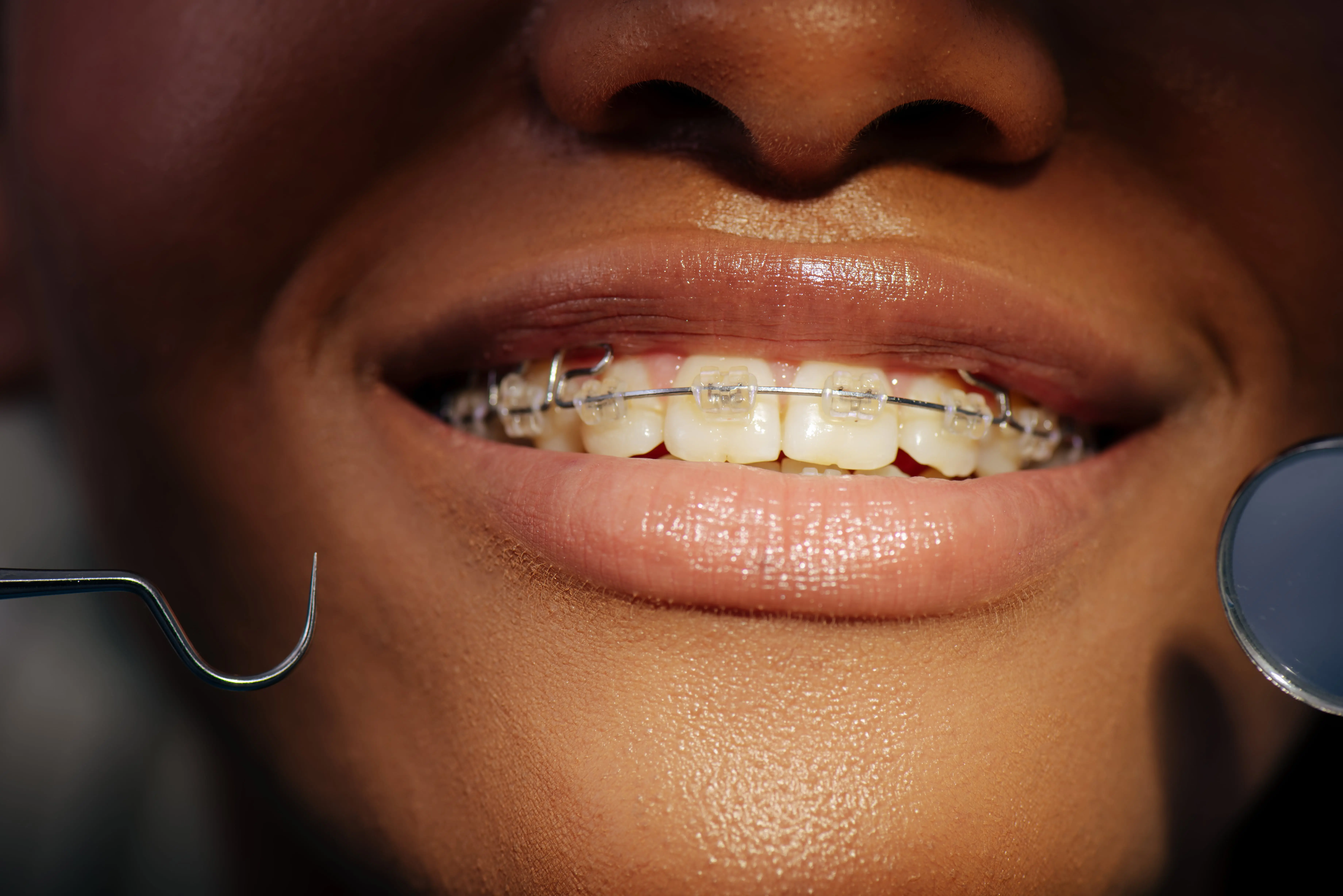 close up smile with braces
