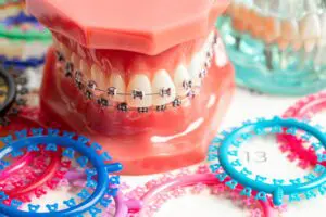 Orthodontic ligatures rings and ties, elastic rubber bands on or