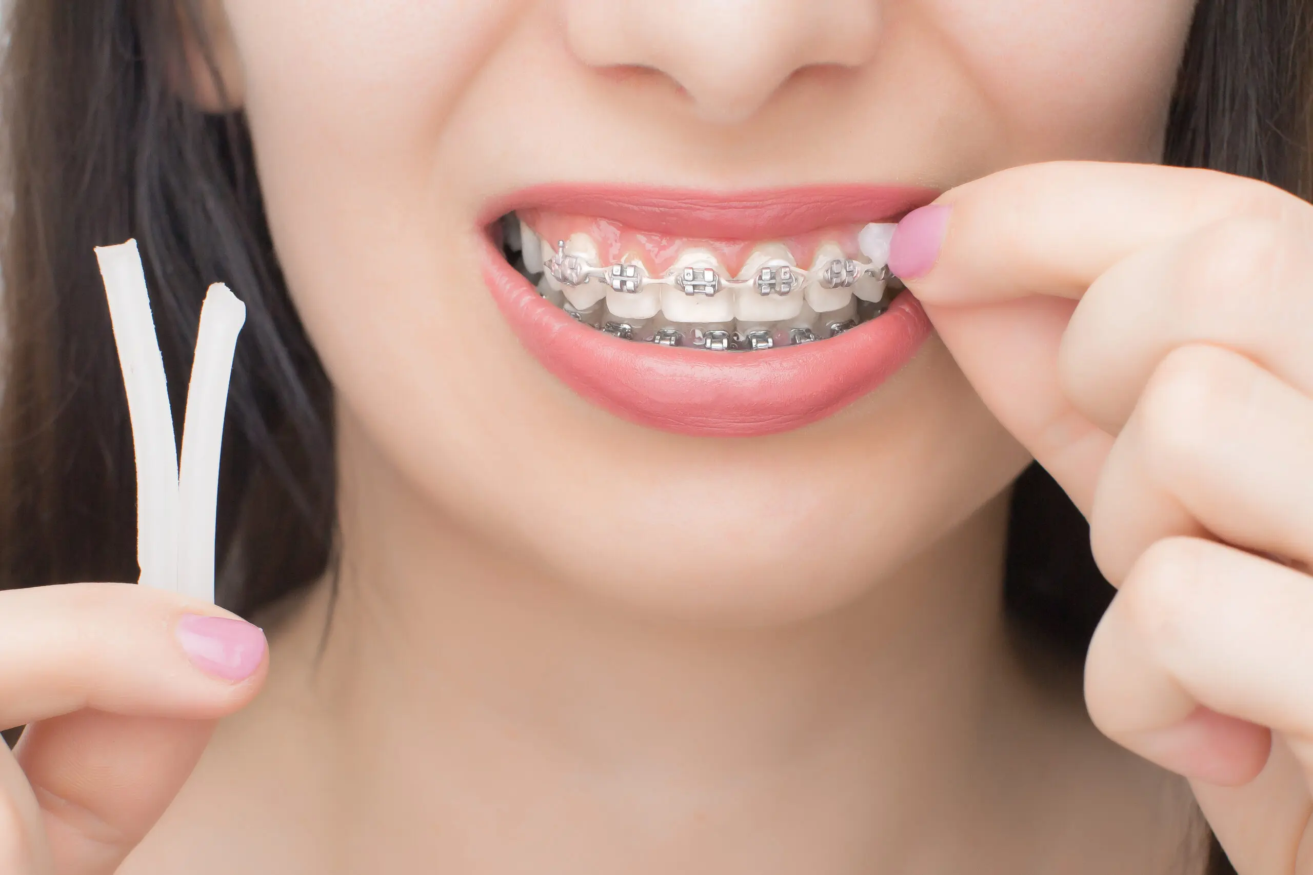Applying orthodontic wax on the dental braces. Brackets on the teeth after whitening. Self-ligating brackets with metal ties and gray elastics or rubber bands for perfect smile