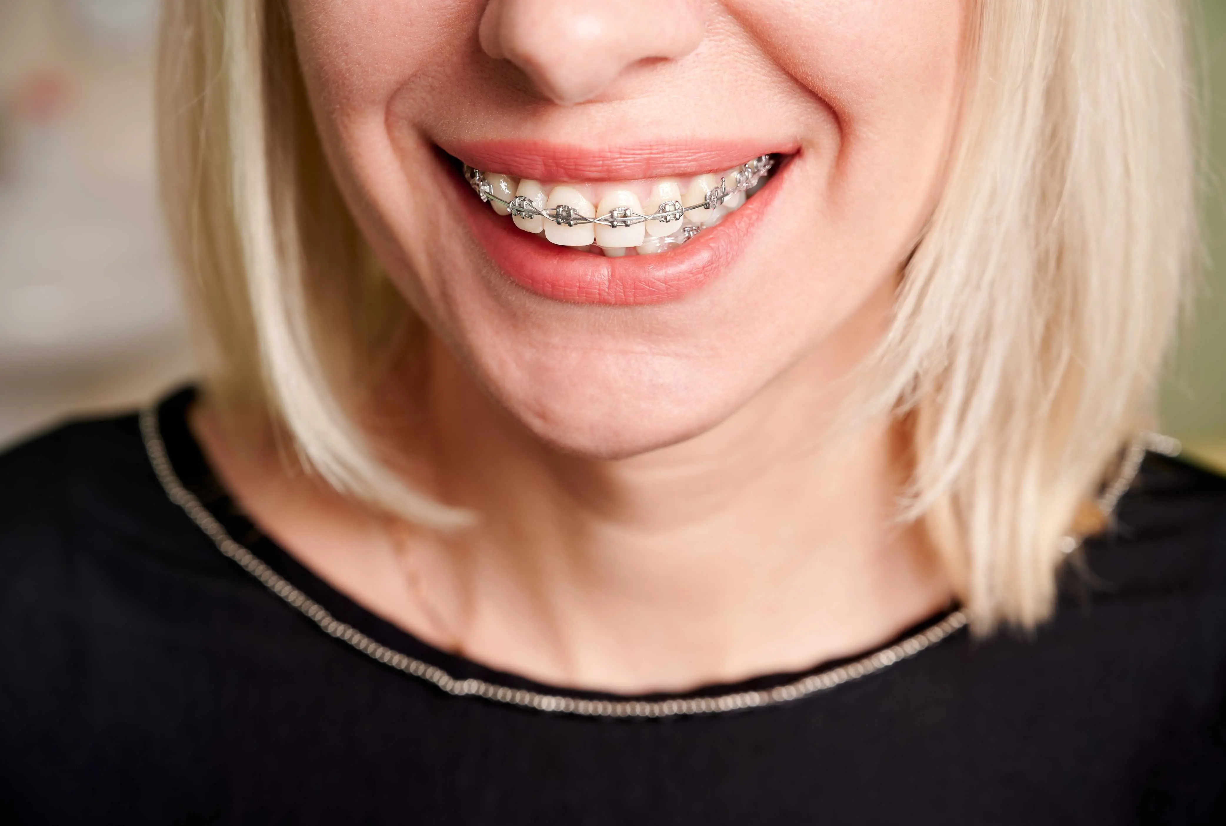 blonde woman with metal braces on teeth