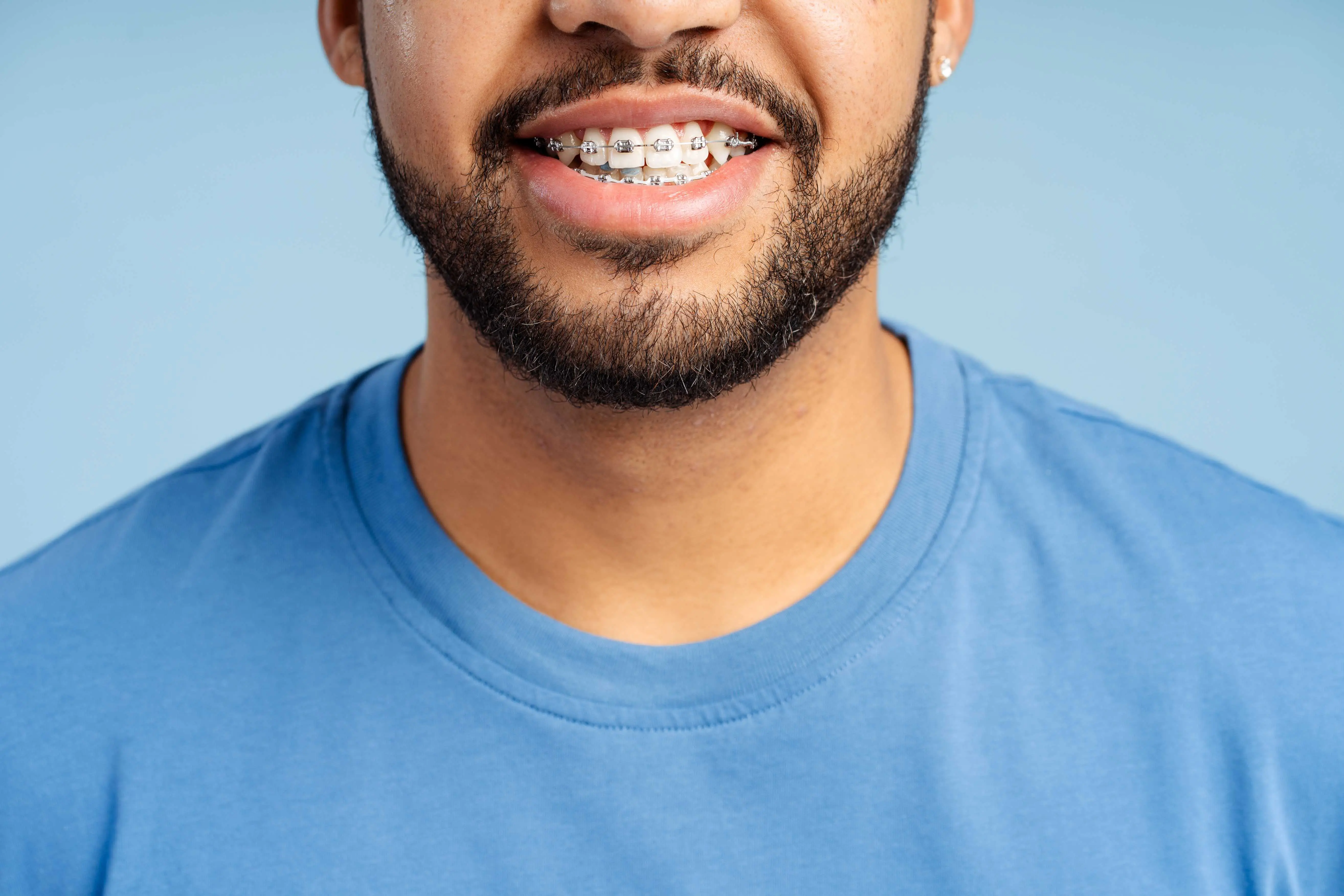 close up of man smiling with braces