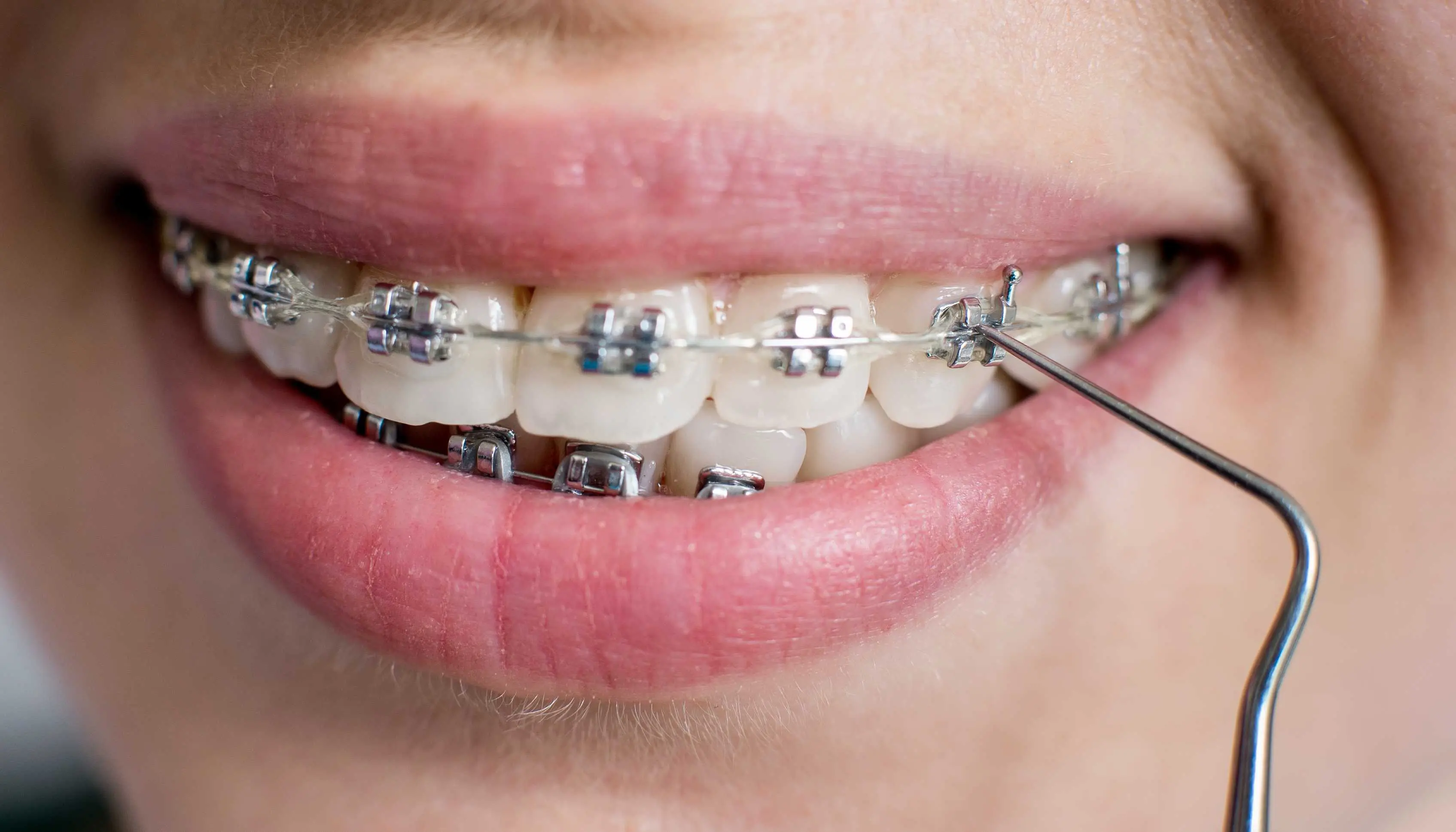 female patient with braces