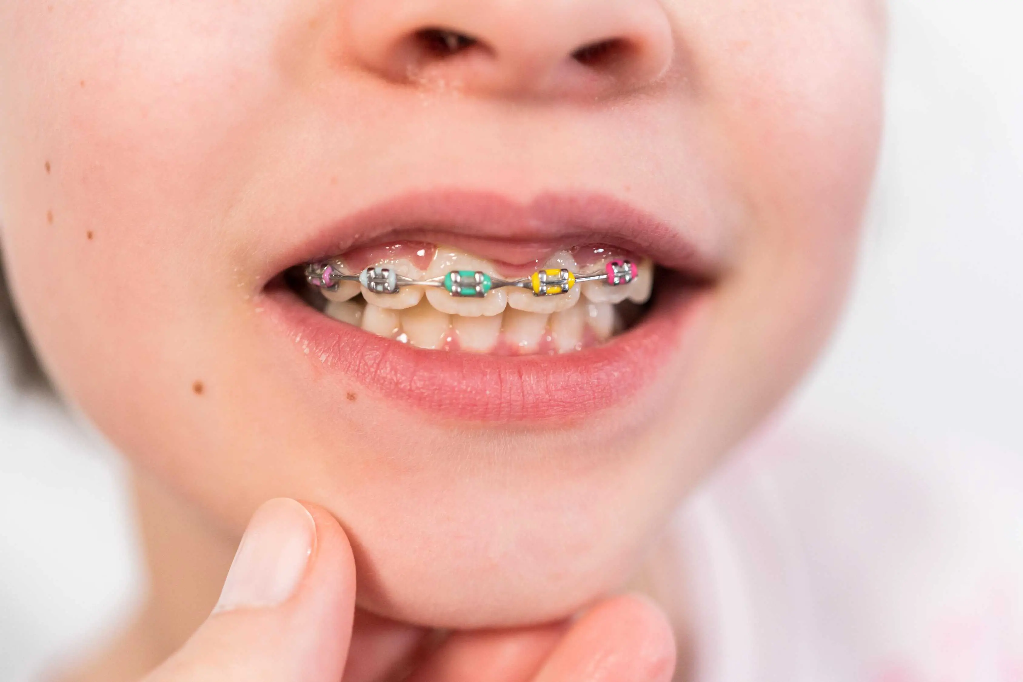 little girl with colored braces
