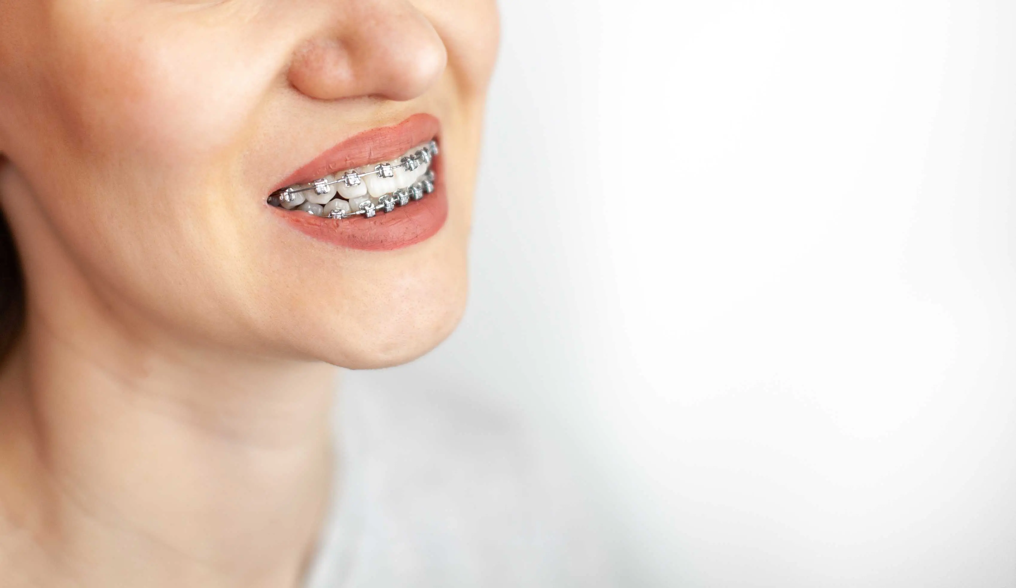young girl with braces on white background