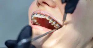 A woman with dental braces visits an orthodontist in the clinic, in a dental chair. during the procedure of installing the arch of braces on the upper and lower teeth. The dentist is wearing gloves and has dental instruments in his hands. The concept of dentistry