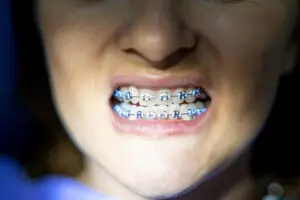 Close up shot of woman with braces on teeth