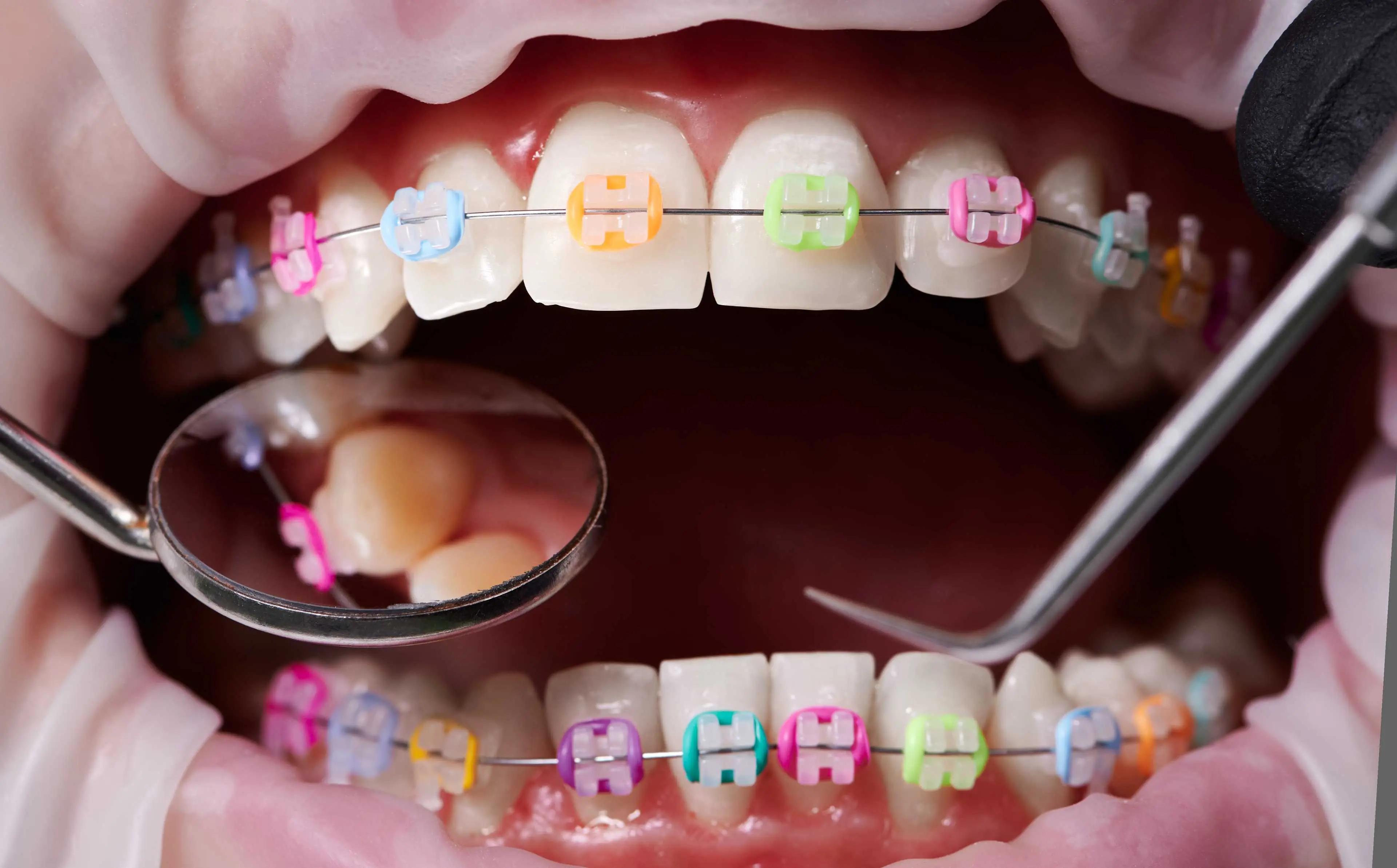 dental procedures with colored brace brands