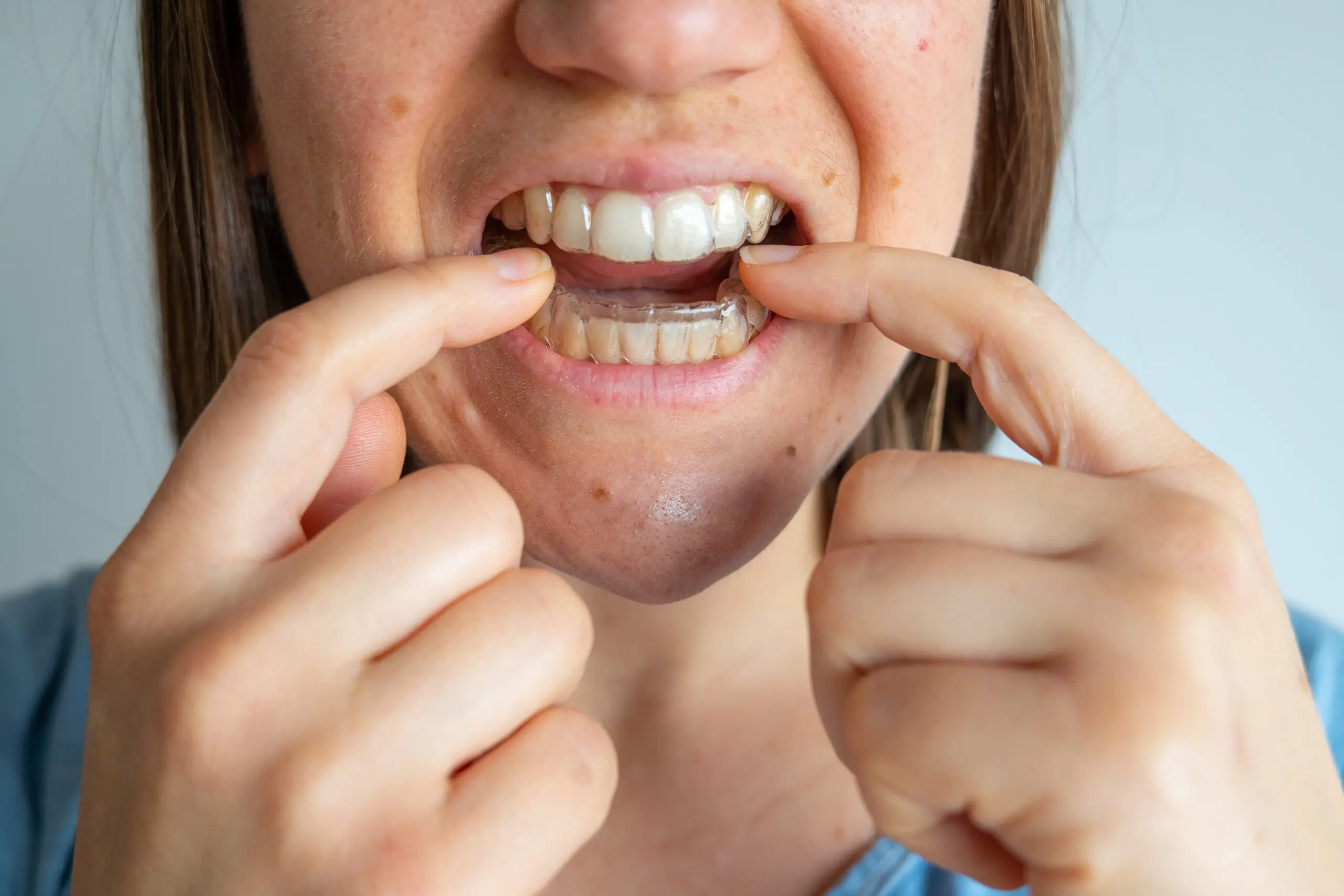 Woman is placing invisible braces aligner orthodontic in her mouth for dental healthcare