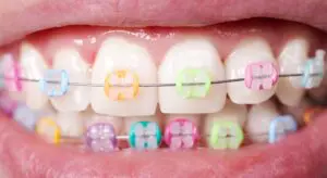 Colorful braces on teeth