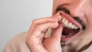 Male hand applying dental aligner retainer of dental clinic for beautiful teeth treatment. Orthodontic removable straighteners in dentist office.