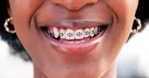 woman smiling with braces