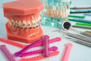 Orthodontic ligatures rings and ties, elastic rubber bands on orthodontic braces, model for dentist studying about dentistry.