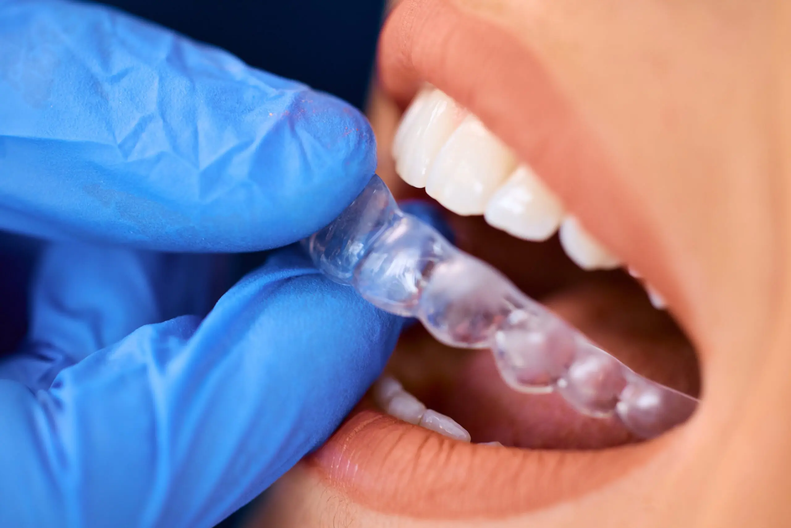 close-up-of-dentist-placing-invisible-dental-align