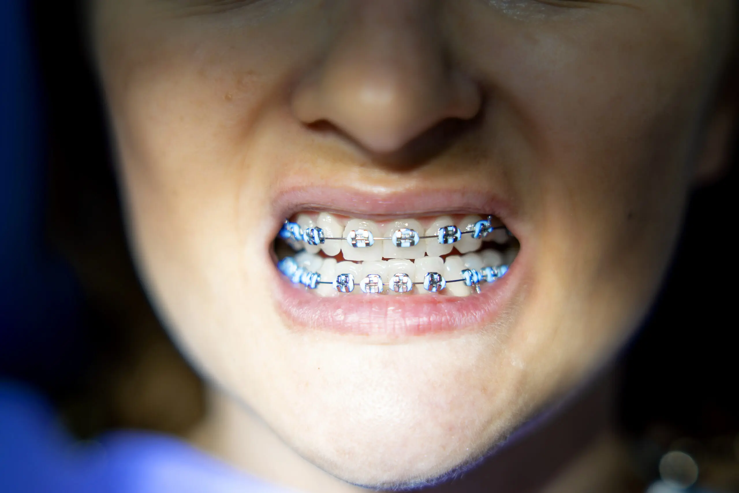 Close up shot of woman with braces on teeth