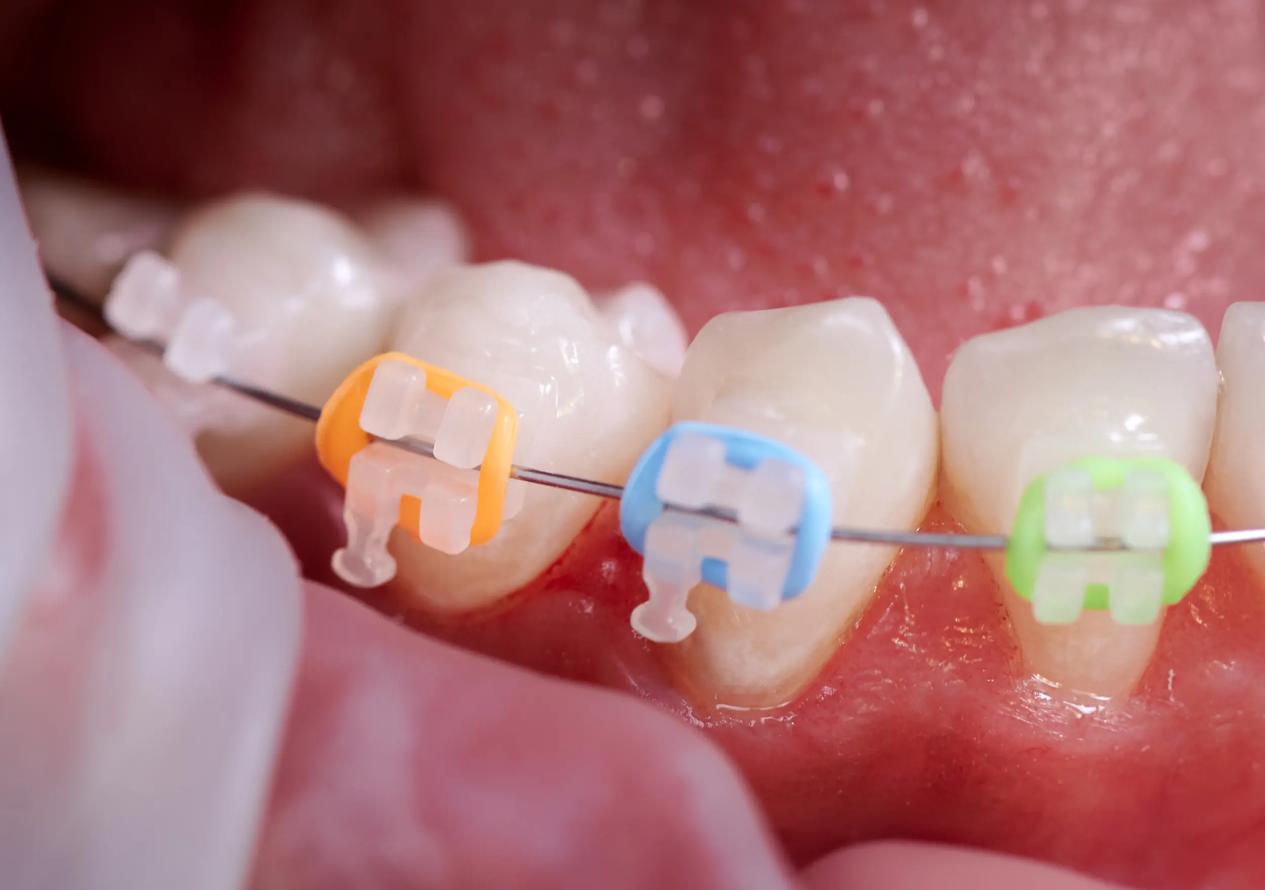 white teeth and ceramic braces with colorful rubber bands on them