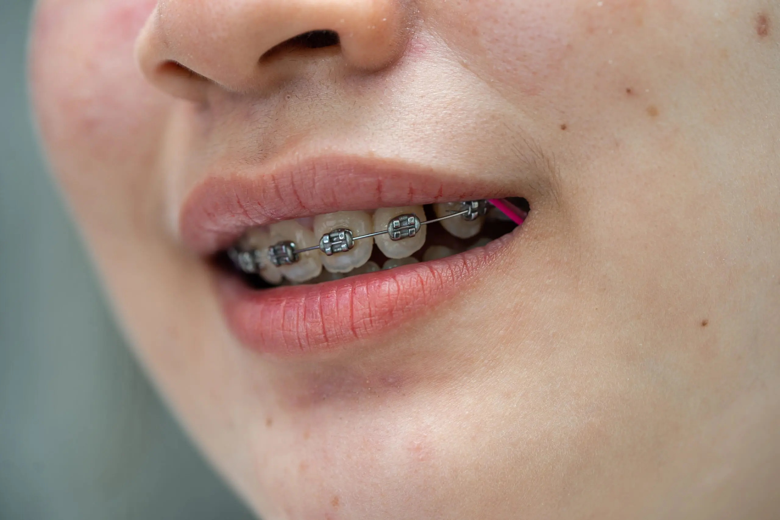 braces-in-teenage-girl-mouth-to-treat-and-beauty-f-2025-02-24-14-01-26-utc-min