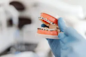 Gloved hand holding a dental model fitted with metal braces