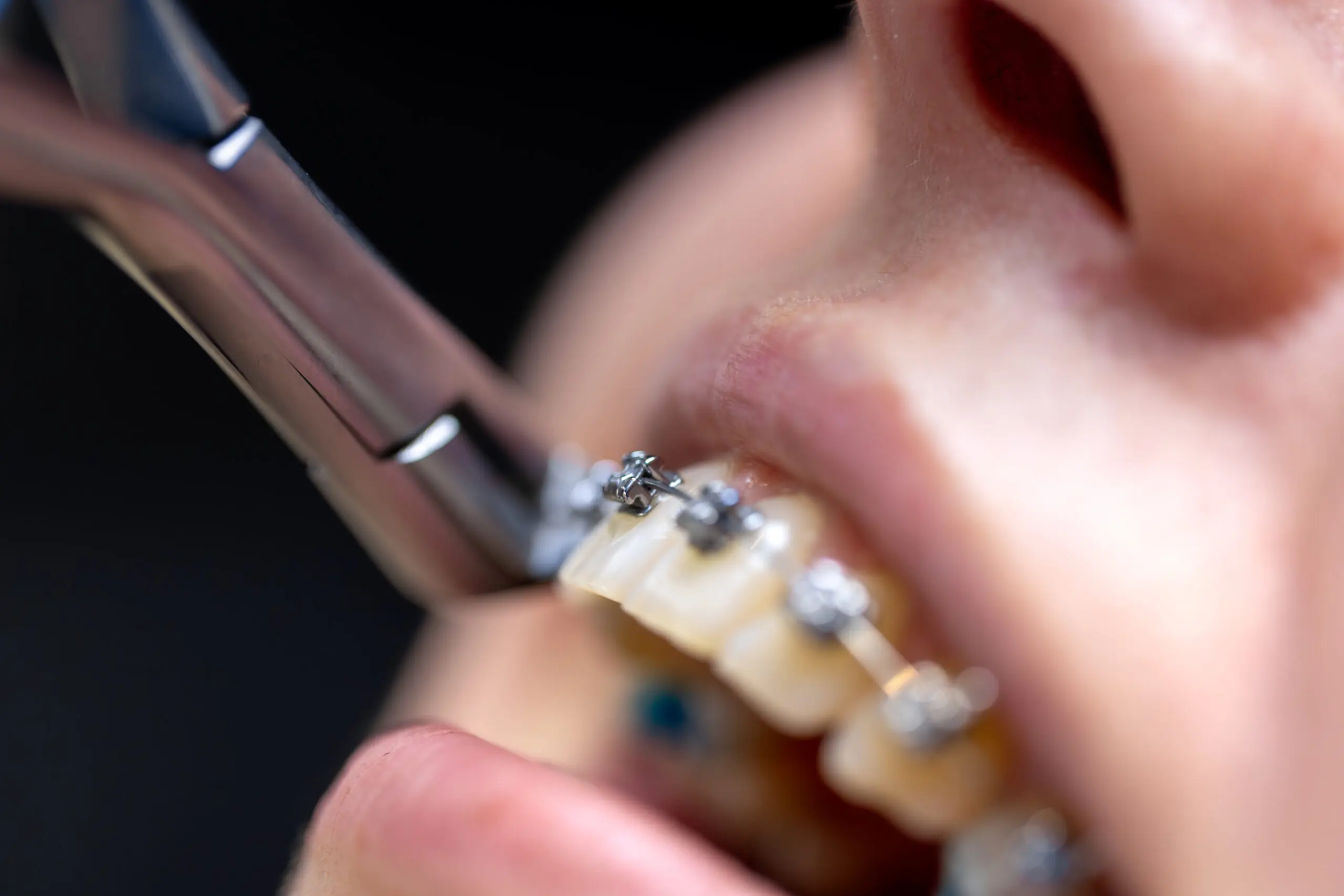 Dental procedure for installing braces close up. Dentistry. Braces on the teeth. High quality photo. Professional dental treatment. Doctor and patient.