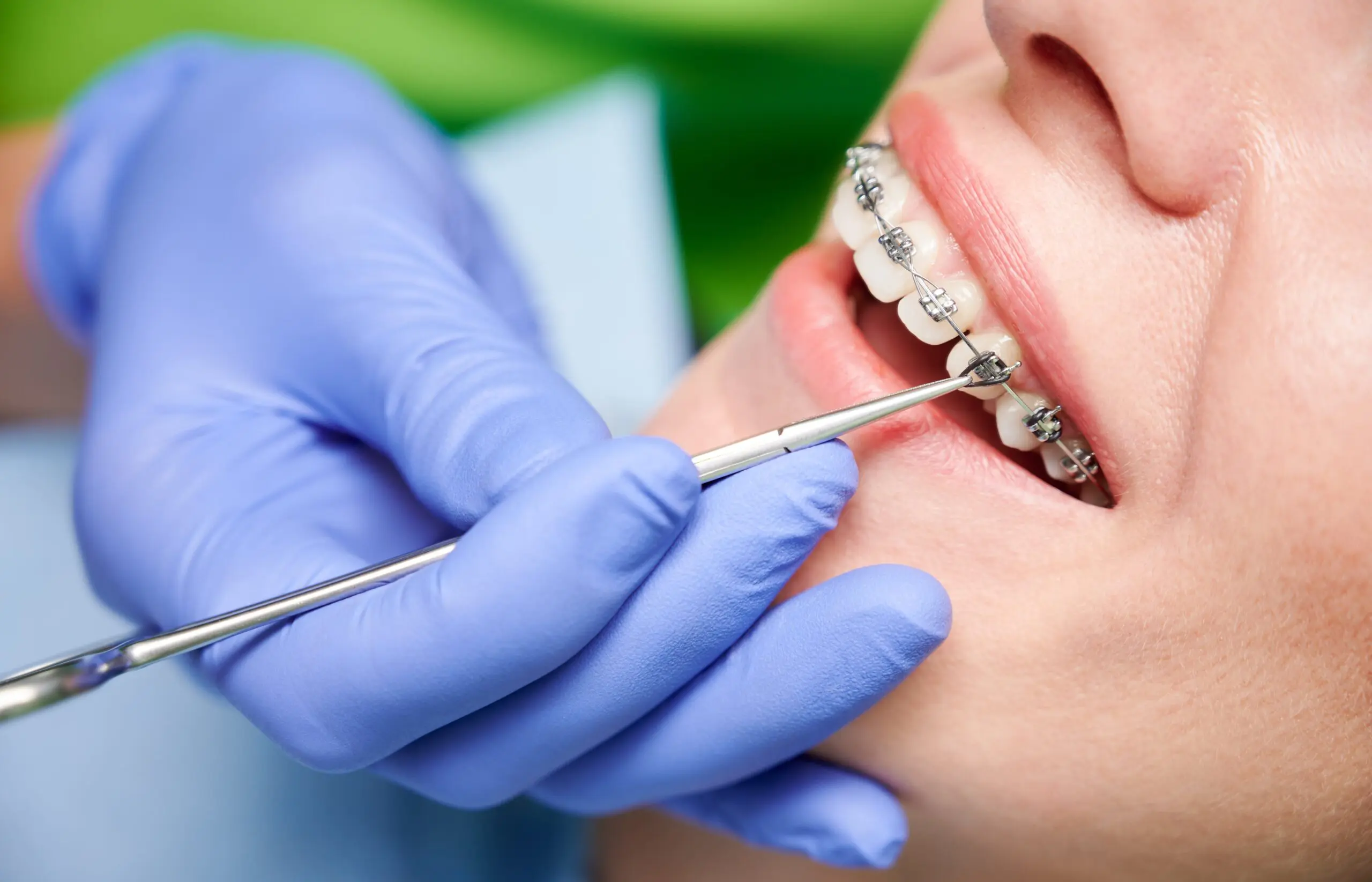 orthodontist hands placing braces on woman teeth