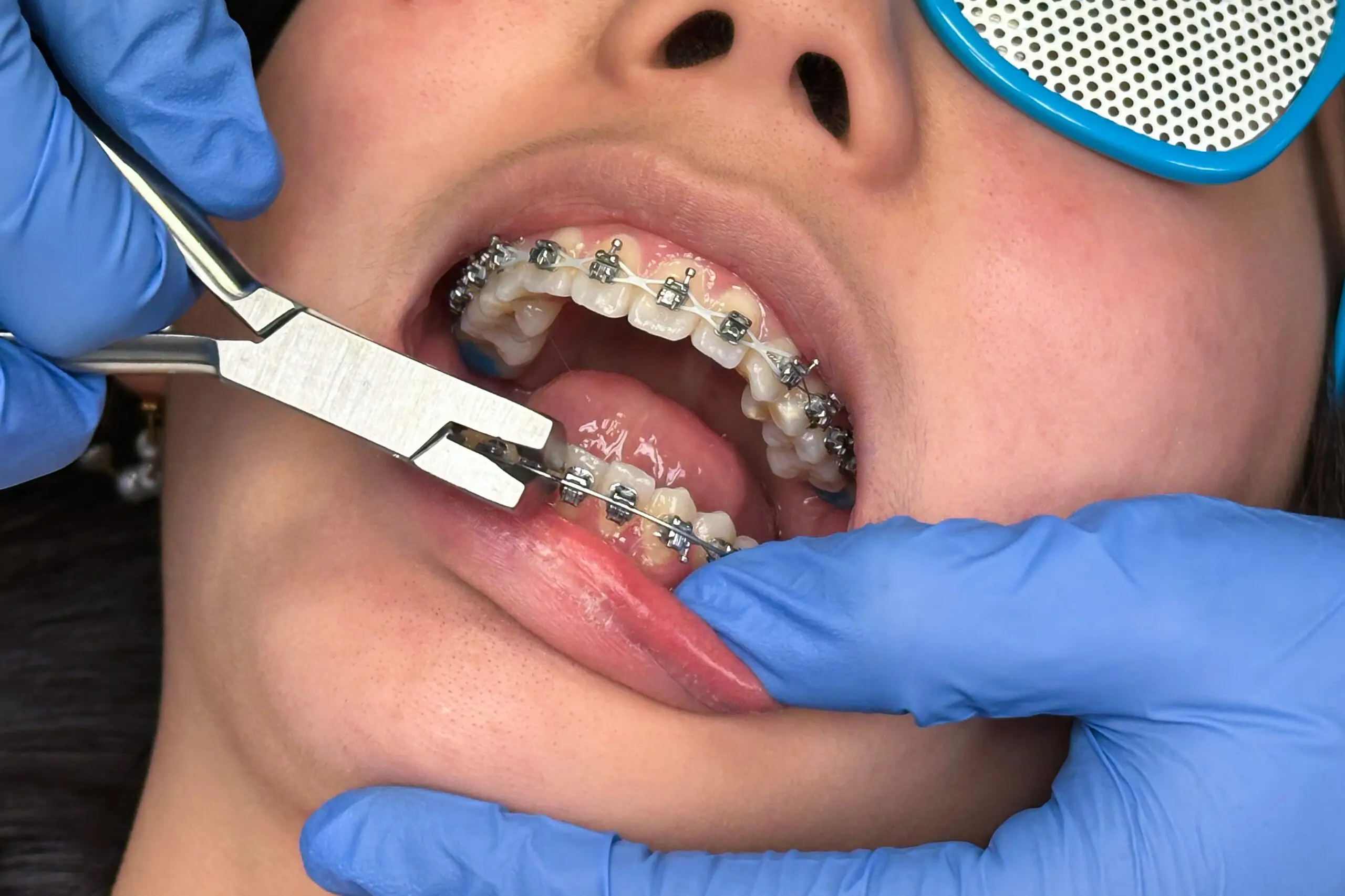 Orthodontist treatment installing braces system on a teen.