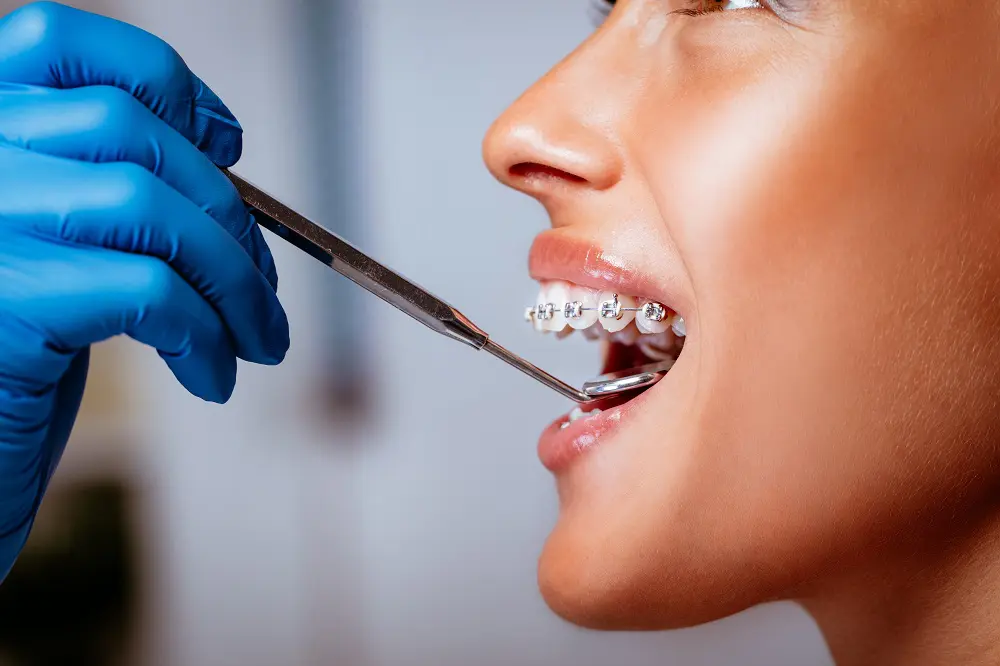 Close-up of a dentist checking braces with a dental mirror on the young female patient.
