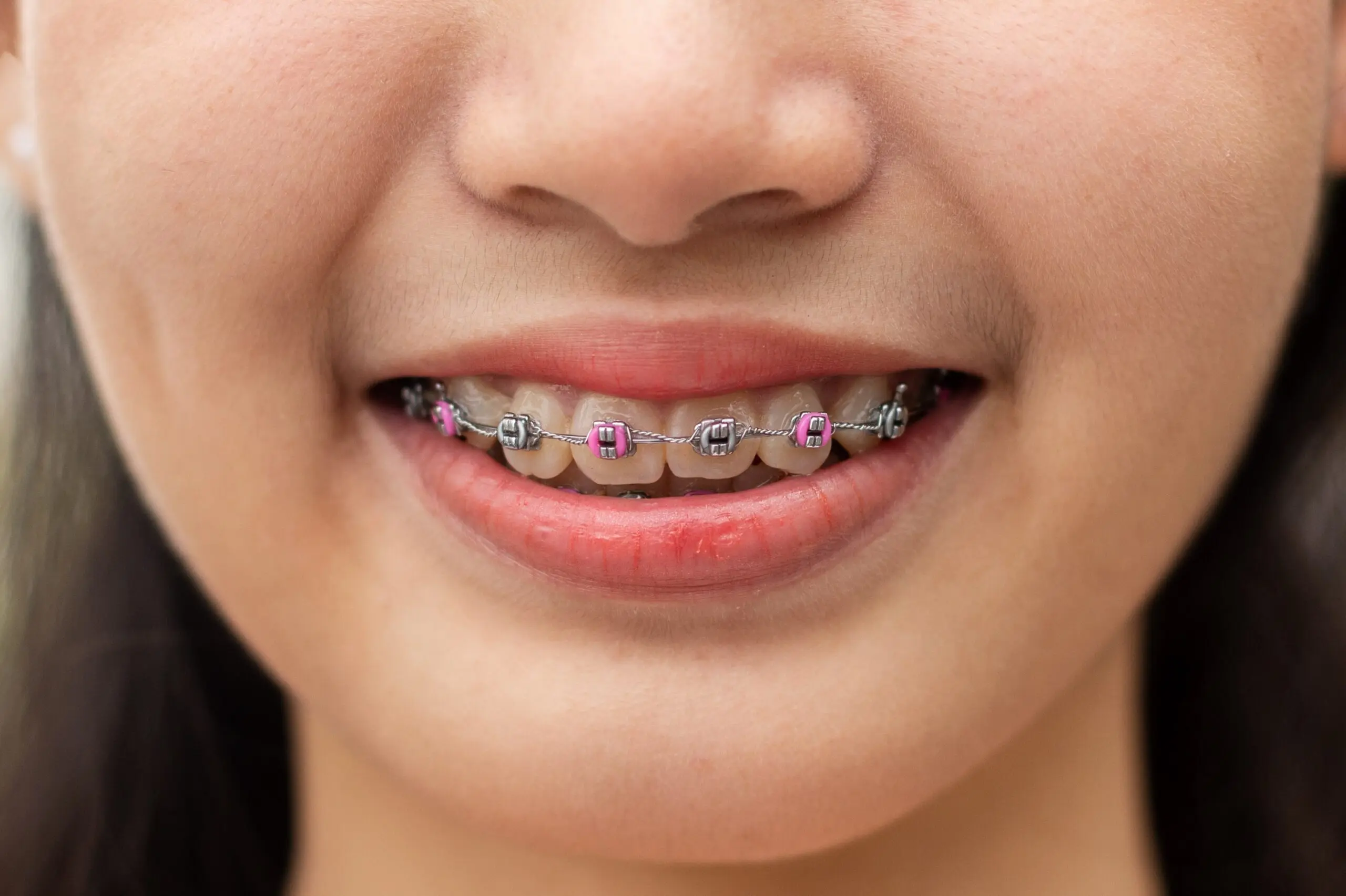 teeth with braces
