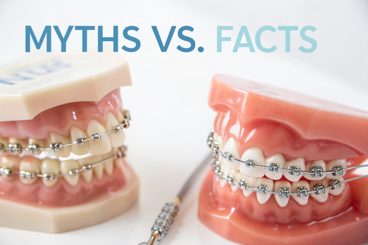 metal-orthodontic-braces--myths-vs--facts