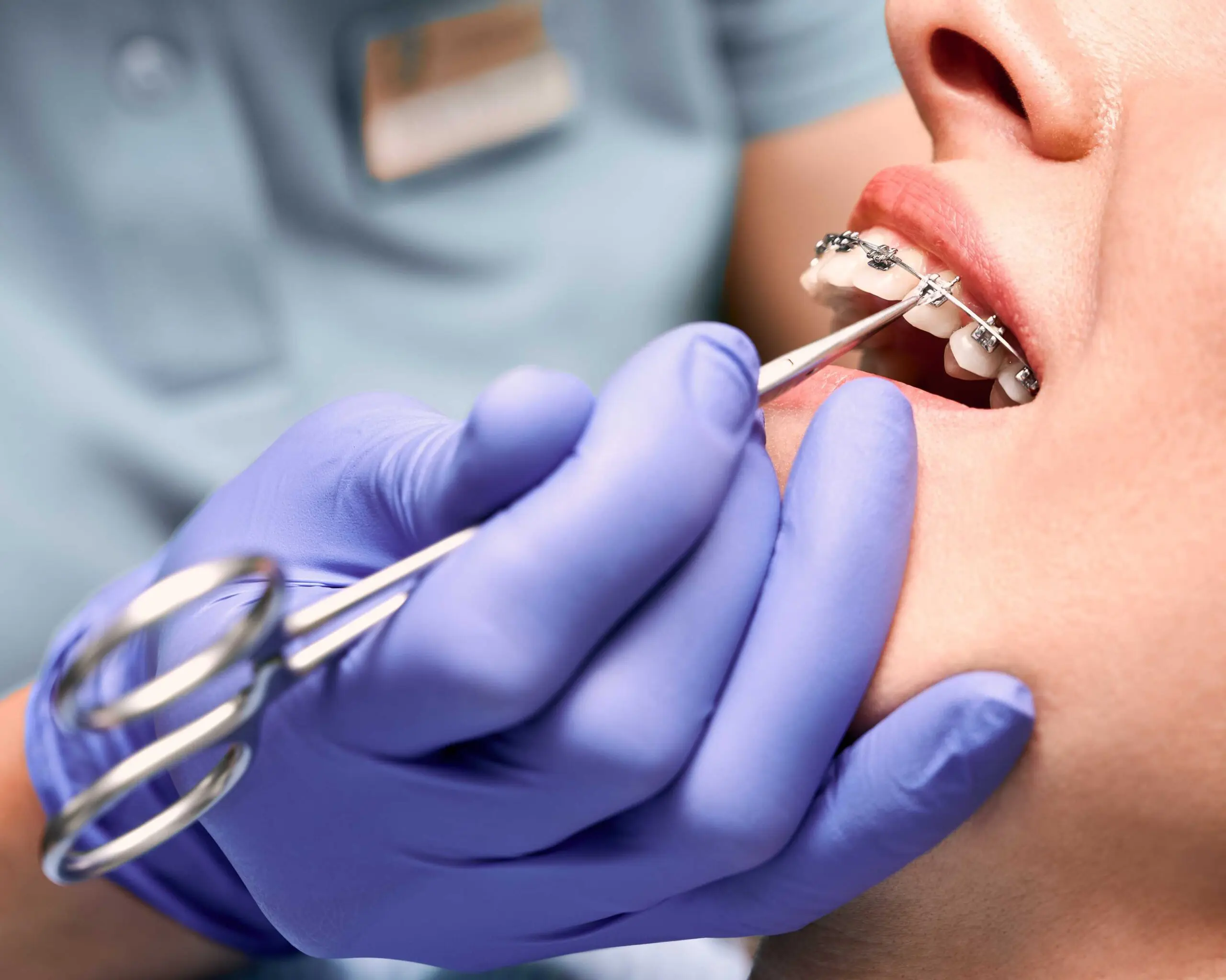 orthodontist placing rubber on womans braces